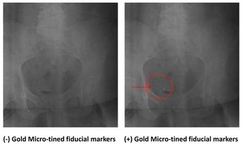 Plain-film X-Ray images of the pelvis without (left) and with (right ...