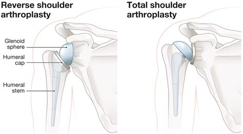 SURGERY FOR ARTHRITIS - David Graham