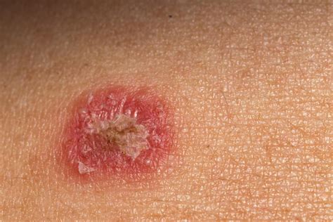 Psoriasis or ringworm? Symptoms, treatment, and other rashes