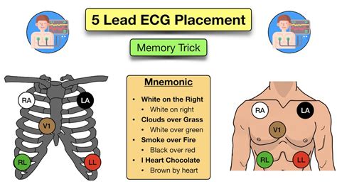 How to Place a 5 Lead ECG: Acronym, Mnemonic, Diagram for Electrode ...