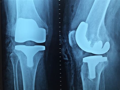 Orthopedic Surgery Types | 68 Types of Orthopedic Surgery