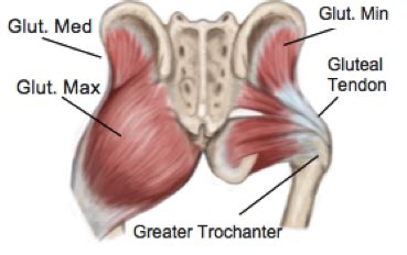 Gluteal Tendinopathy - physioFIX