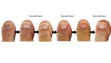 Nail Infection - Fungal. Causes, symptoms, treatment Nail Infection ...