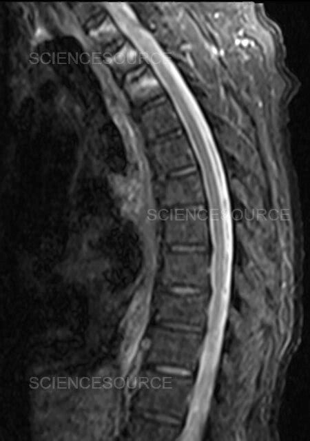 Photograph | Bone marrow edema, MRI | Science Source Images