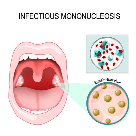 mononucleosis infección - Canal Chupete