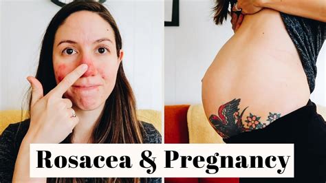 ROSACEA, BENIGN PLACENTAL LAKES & MORE | 22 week pregnancy update - YouTube