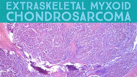 10 Symptoms of extraskeletal myxoid chondrosarcoma You Should Never ...