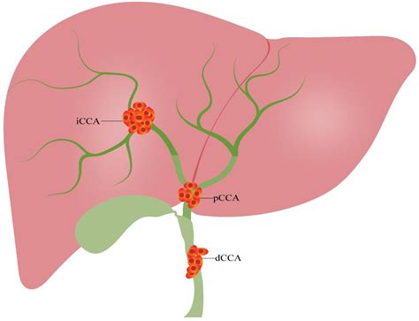 Cancers | Free Full-Text | The Role of Single-Nucleotide Polymorphisms ...