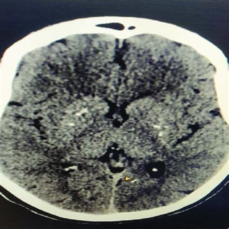 CT head showing bilateral basal ganglia calcification | Download ...