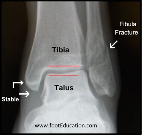 Ankle Fracture - FootEducation