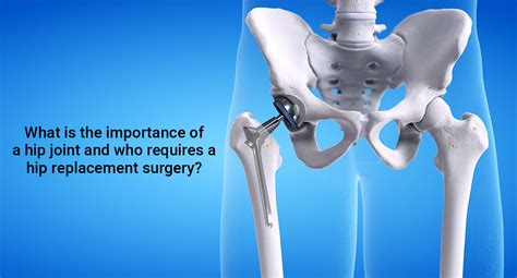 What is the importance of a hip joint and who requires hip replacement ...