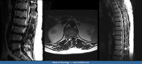 Herniated Disc Thoracic Mri