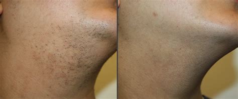 Laser Hair Removal Before And After