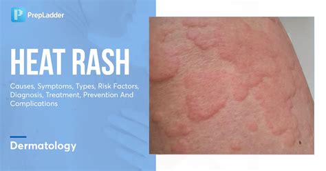 Heat Rash: Causes, Symptoms, Types, Risk Factors & More