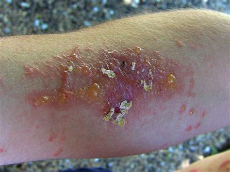 Poison ivy rash: Causes, treatment, and prevention