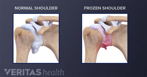 Frozen Shoulder Causes and Risk Factors