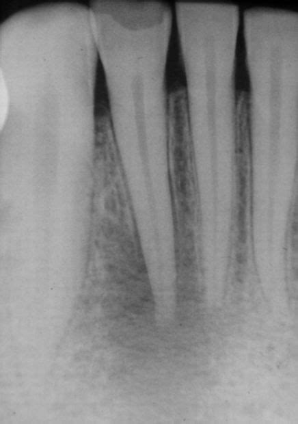 Apical periodontitis