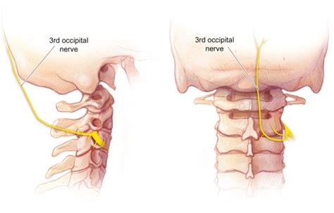 The course of the third occipital nerve as it traverses over the C2-3 ...