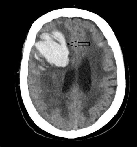 Does a Spontaneous Intracerebral Hemorrhage Predispose to a Secondary ...