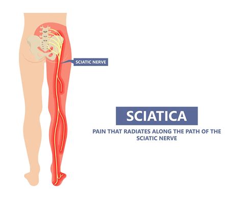 Pinched Nerve Relief. How to Know if it’s a Pinched Nerve - North ...