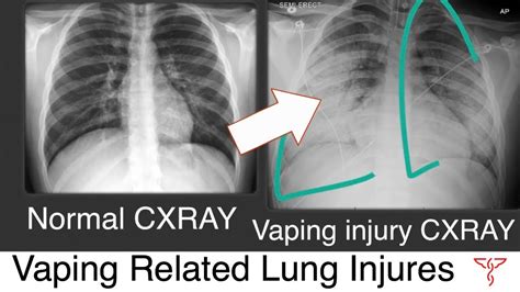 How Vaping Related Lung Injuries Occur - YouTube