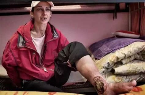 Flesh-eating drug Krokodil has hit the UK - Pattaya One News