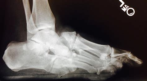 Treatment Alternatives in Charcot Arthropathy of the Foot | Duke Health ...