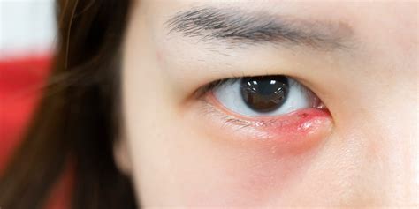 All About Eye Styes-Stye Causes, Treatment and Prevention - Dr. Jiwani ...