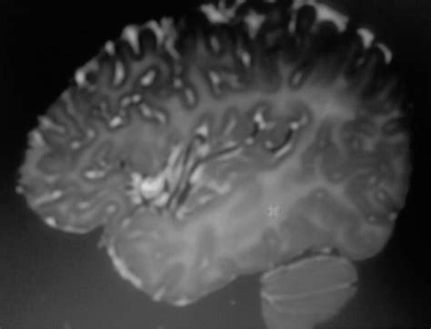 PMD leukodystrophy :MRI - Sumer's Radiology Blog