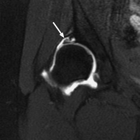 Imaging of the Acetabular Labrum | Musculoskeletal Key