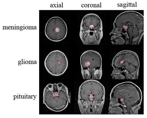 GitHub - ansamz/MRI-Brain-Tumor-detector: Trying different image ...