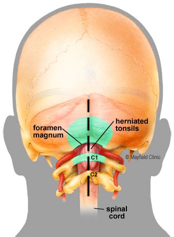 Chiari Decompression | Neurosurgery located in Fort Worth, Granbury ...