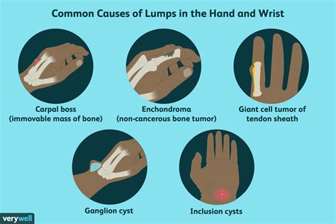 Lump on Wrist or Hand: 8 Causes and Treatment