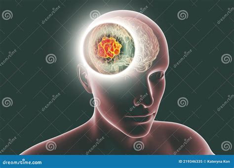 Brain Mucormycosis, a Brain Lesion Caused by Fungi Mucor Stock ...