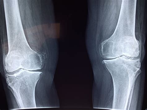 Normal Knee X Ray Anatomy