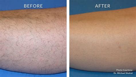 Laser hair removal before and after