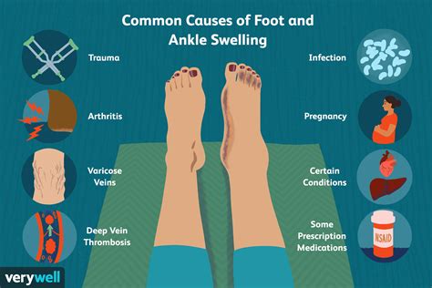 Swollen Ankles And Pregnancy : How To Deal With Swollen Feet During ...