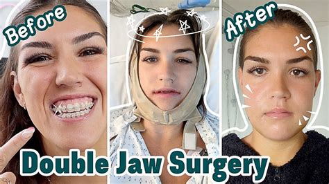 6 DAYS AFTER DOUBLE JAW SURGERY! (Jaw Surgery Recovery Vlog) Ep. 4 in ...