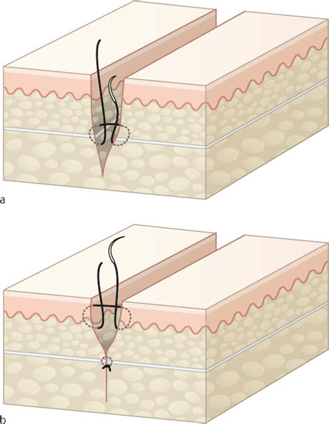 10 Wound closure and coverage techniques (I) | Musculoskeletal Key