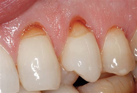 What is the difference between dental attrition, abfraction, erosion ...