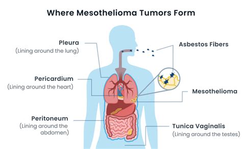 Malignant Mesothelioma: Types, Symptoms & Prognosis