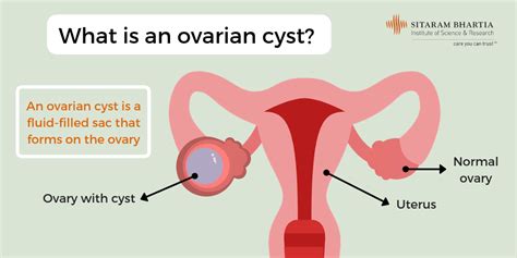 Ovarian Cyst Nursing Care Plan