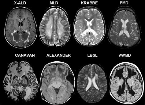 Lesion Patterns on Conventional MRI in Leukodystrophies and ...