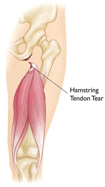 Hamstring Injury Exercises / Proximal Hamstring Tendinopathy Exercise ...