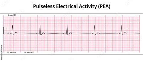 ECG Pulseless Electrical Activity (PEA) - 8 Second ECG Paper ...