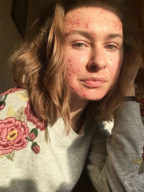 Woman Inspires Others With Acne To Go Makeup Free | Media Drum World