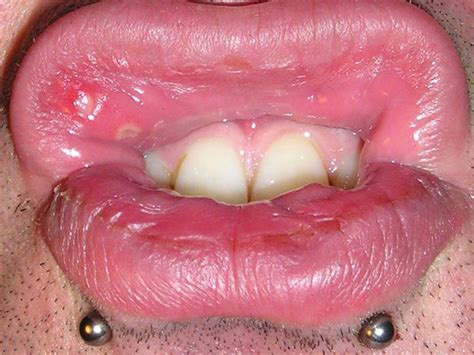 Mouth Ulcers: Causes, Symptoms, Treatment & Prevention - Boldsky.com