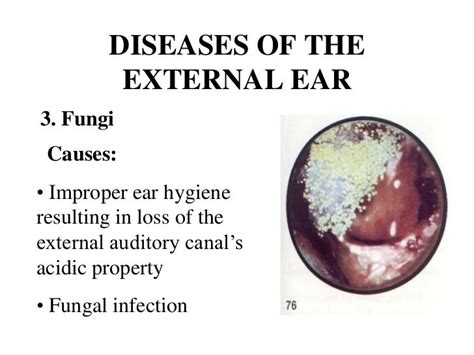 Common Ear Diseases