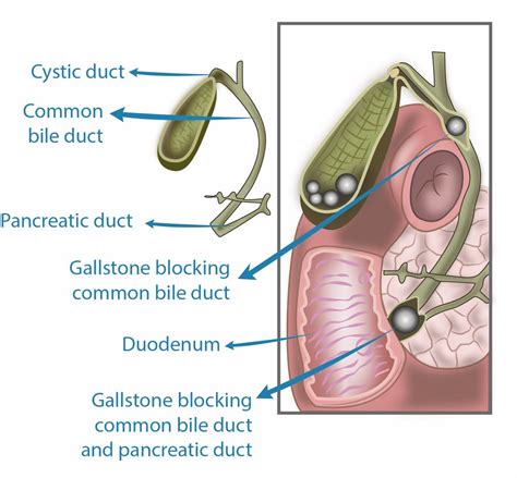 Common Bile Duct Stones - Treatment at Hernia Gallbladder Centre Perth