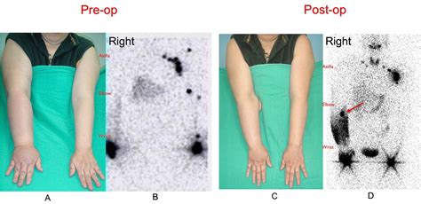 Vascularized Lymph Node Flap Transfer (VLNT) Surgery | Ming-Huei Cheng, MD